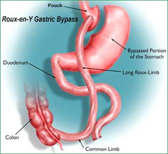 rouxeny-gastric-bypass