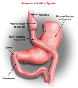 sharma-obesity-gastric_bypass_roux-en-y3